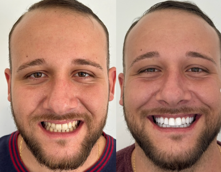 Antes e depois — procedimento 9